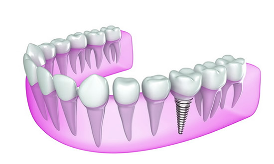 imagen de implante dental 