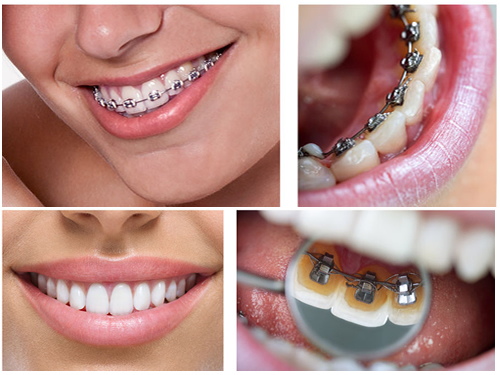 Mejorar la sonrisa mediante ortodoncia